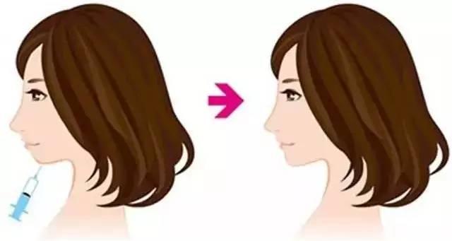 玻尿酸丰下巴视频,轻松打造完美下巴轮廓